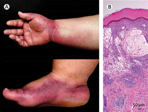 Papular purpuric gloves and socks syndrome, causes, symptoms, diagnosis ...