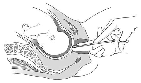 5.3 Artificial rupture of the membranes | MSF Medical Guidelines