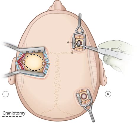 2 Chronic Subdural Hematomas | Neupsy Key