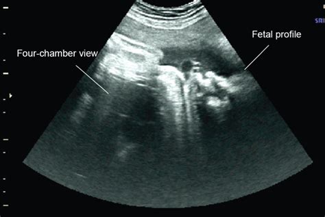 Sonographic diagnosis of lateral asynclitism: a new subtype of fetal head malposition as a main ...