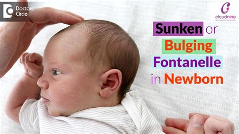 Bulging Fontanel: Causes, Treatments, And When To See A, 60% OFF