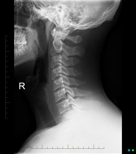 SplintER Series: A Temporary Pain in the Neck