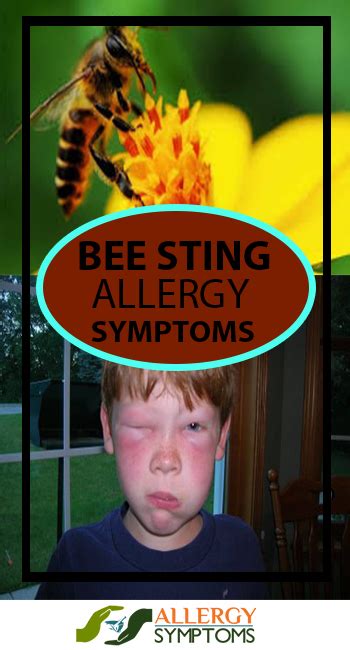 Bee Sting Allergy Symptoms & Diagnosis - Allergy Symptoms