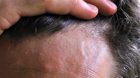 Management of Scalp Psoriasis | 1mhealthtips.com