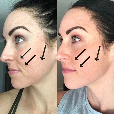 My Experience w/ Microneedling & Why I'm Obsessed - PaleOMG