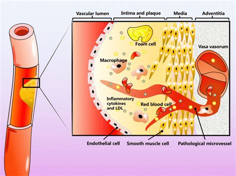 Pathological microvessels from the adventitial vasa vasorum transport ...