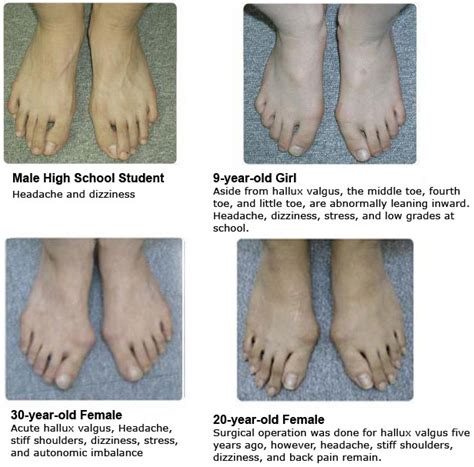 Hallux Valgus (Bunion Deformity) Can Make You Sick