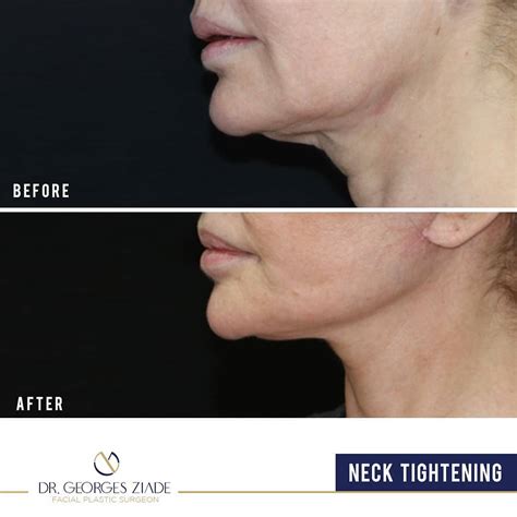 Neck Tightening – Dr. Georges Ziade Clinics