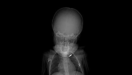 TASER injury to eye | Radiology Case | Radiopaedia.org