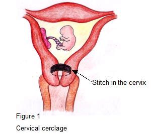 Shirodkar Cerclage Procedure - RNpedia