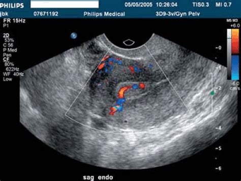 Transvaginal Ultrasound and the Hysteroscopic Surgeon | Abdominal Key