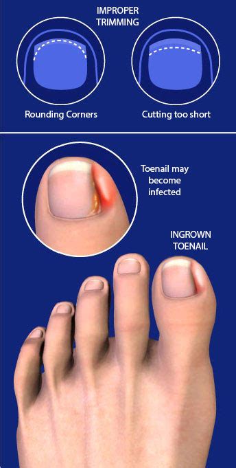 Fix Your Feet | Ingrown Toenails