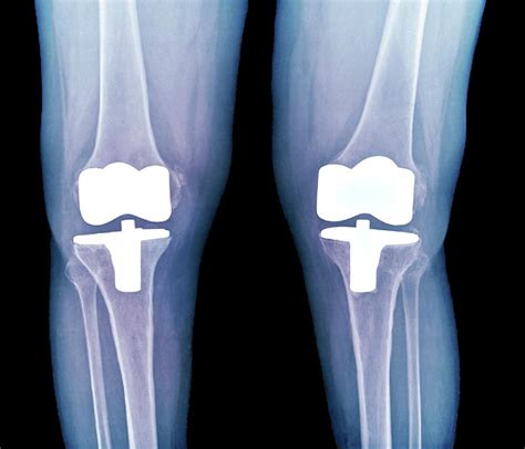 Bilateral Total Knee Replacement Photograph by Zephyr/science Photo ...