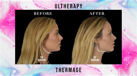 Ultherapy vs Thermage: Non Surgical Facelift with Collagen Stimulation | Wave Plastic Surgery ...