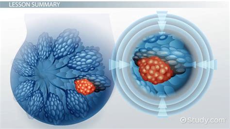 What is a Malignant Tumor? - Definition & Treatment - Lesson | Study.com