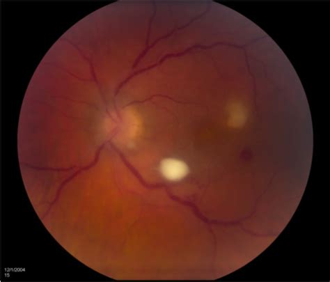 Endogenous fungal endophthalmitis caused by yeast. A 34-year-old ...