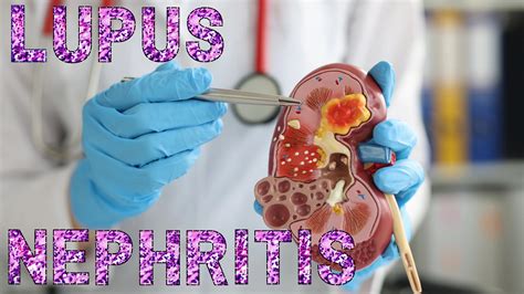 Exploring the Essentials: 7 Vital Questions Regarding Lupus Nephritis ...