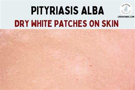 Pityriasis Alba: What causes these dry white patches on skin?