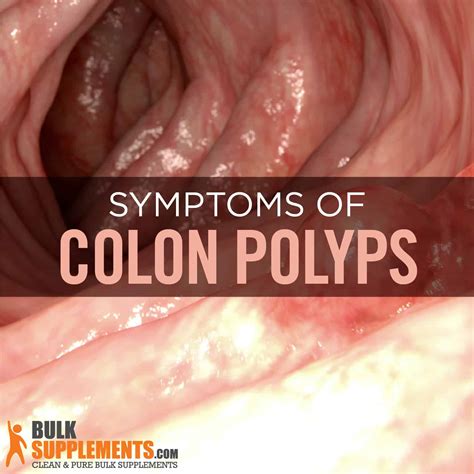 Colon Polyps: Symptoms, Causes & Treatment