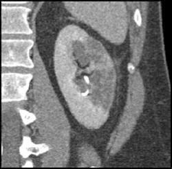 Renal Infarct - Kidney Case Studies - CTisus CT Scanning