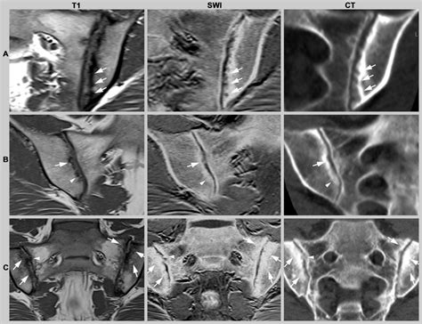 Illustration of structural changes of the sacroiliac joint in ...