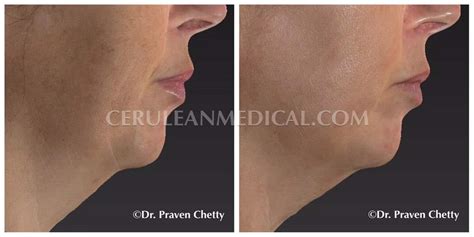 IPL-before-and-After-Photo-1 - Cerulean Medical Institute - Kelowna BC