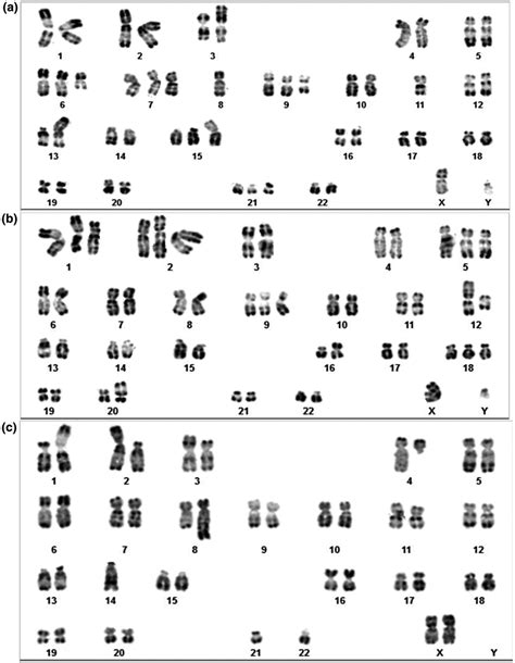 Abnormal bone marrow Karyotypes examples. A, Karyotype of male with... | Download Scientific Diagram