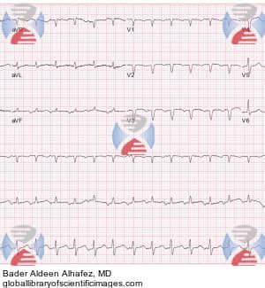 Atrial Tachycardia ECG | Global Library of Scientific Images