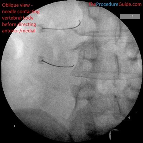 Lumbar Sympathetic Block - Technique and Overview - The Procedure Guide