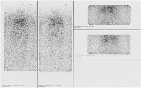 MIBG scan showed left adrenal mass | Download Scientific Diagram