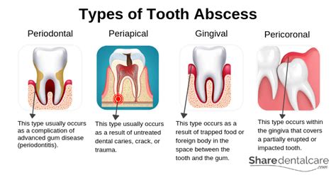 Periodontal Abscess: Symptoms, Causes & Treatment - Share Dental Care (2023)