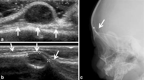 Dermoid and epidermoid cysts. a Dermoid cyst in a 1-month-old girl who ...