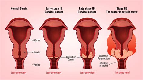 Cervical Cancer Stages | YourCareEverywhere