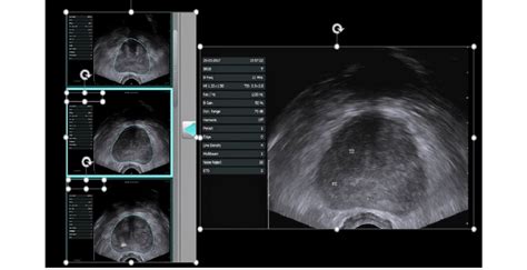 Transrectal Ultrasound. | Download Scientific Diagram