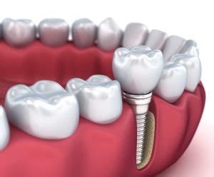 Endosteal Dental Implants | Loveland, CO Dentist