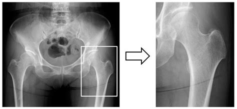 Medicina | Free Full-Text | Effect of Patient Clinical Variables in Osteoporosis Classification ...