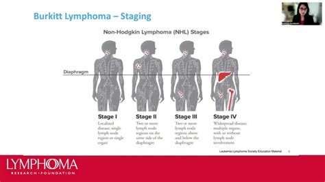 Understanding Burkitt Lymphoma: Causes, Symptoms, and Treatment - Ask The Nurse Expert