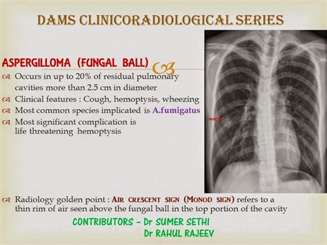 Aspergilloma: Clinicoradiological Series - Sumer's Radiology Blog