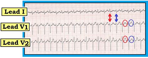 ECG Interpretation: ECG Interpretation Review #83 (PSVT – AVNRT – AVRT – Alternans – Electrical ...