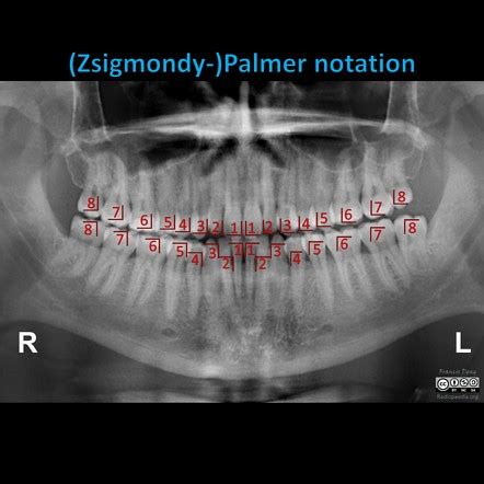 Palmer notation | Radiology Reference Article | Radiopaedia.org