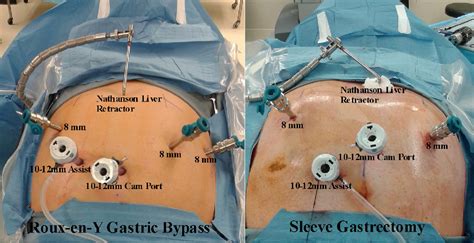 Figure 4 from Perioperative patient care involved with robotic-assisted bariatric surgery ...