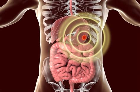 signos de cáncer de estómago archivos - Dr Mauricio León