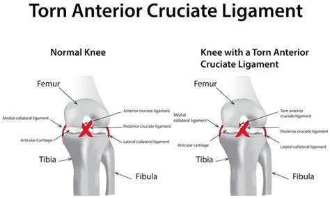 What is Anterior Cruciate Ligament (ACL) Injury? (Symptoms & Reasons)