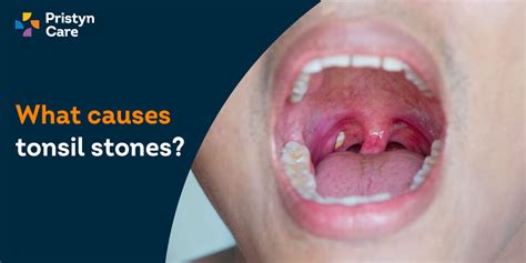 Enlarged Tonsils Grading