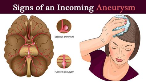 5 Signs it May Be a Brain Aneurysm - WomenWorking