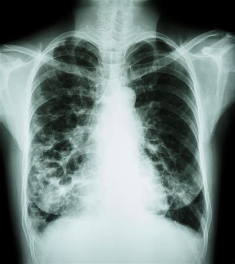 Chest X-Ray for Sarcoidosis Screening in Uveitis Patients Needs More Study