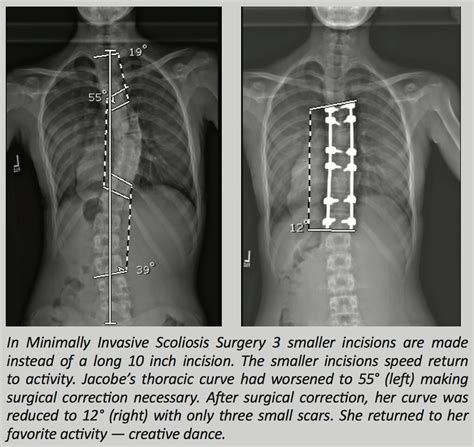 Surgery Scoliosis Scoliosis Xray Human Spine | The Best Porn Website