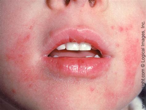 Eczema in Children | National Eczema Association