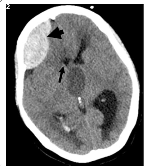 De novo postoperative extradural hematoma. Extradural hematoma was ...