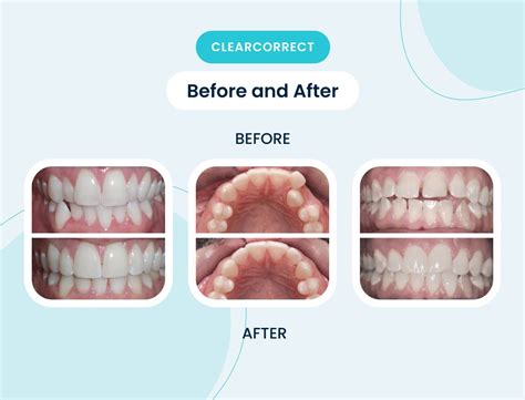 ClearCorrect Teeth Aligners Review: Everything You Need To Know